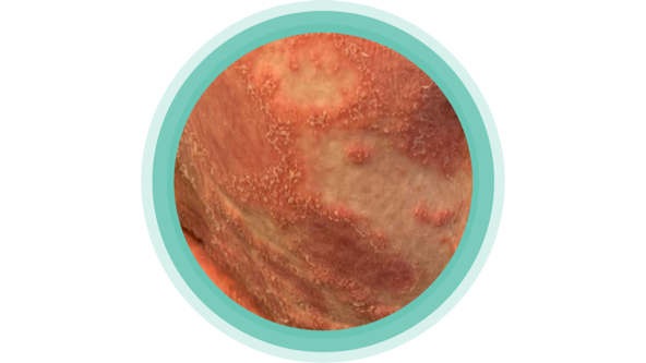 Schübe, Auslöser, weitverbreitete Pusteln, mit der Krankheit GPP umgehen, Act4GPP